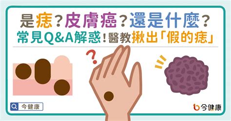 腋下有凸痣|是痣？還是皮膚癌？皮膚科醫師教你揪出「假的痣」，。